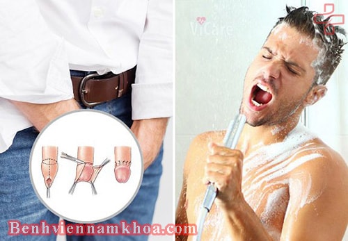 Cắt bao quy đầu xong bị phù nề do đâu