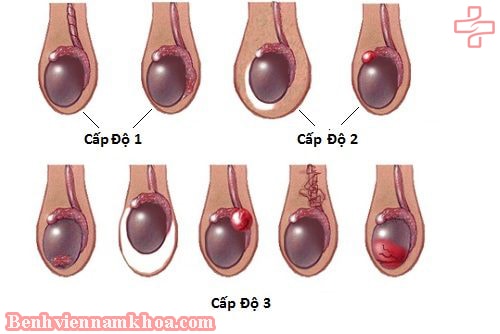 Giãn tĩnh mạch thừng tinh cấp độ 1