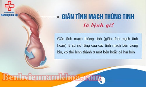 Giãn tĩnh mạch thừng tinh là gì