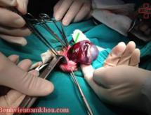Phẫu thuật giãn tĩnh mạch thừng tinh