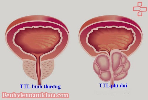 Phì đại tuyến tiền liệt là gì