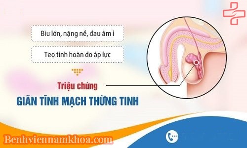 triệu chứng của bệnh giãn tĩnh mạch thừng tinh