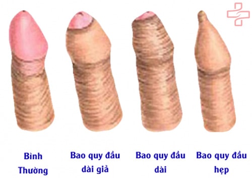 Trường hợp nào bạn nên cắt bao quy đầu