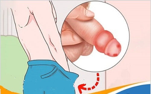 Bao quy đầu bị sưng có nguy hiểm không?