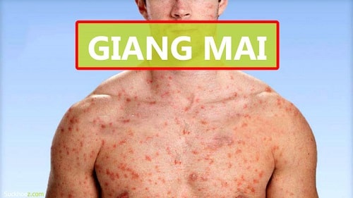 Bệnh giang mai nguy hiểm như thế nào