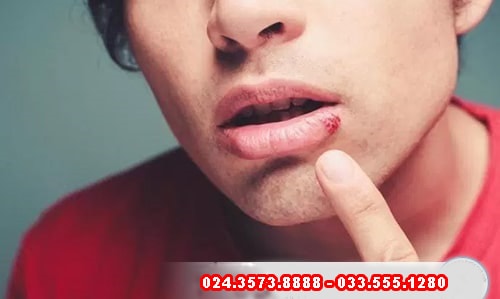 Bệnh lậu ở miệng có chữa được không