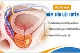 Bệnh viêm tuyến tiền liệt là gì