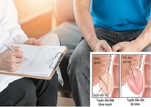 Cách chữa trị viêm tuyến tiền liệt hiệu quả