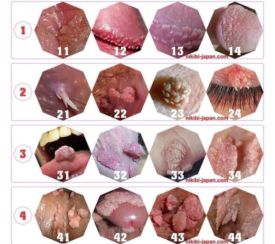sùi mào gà