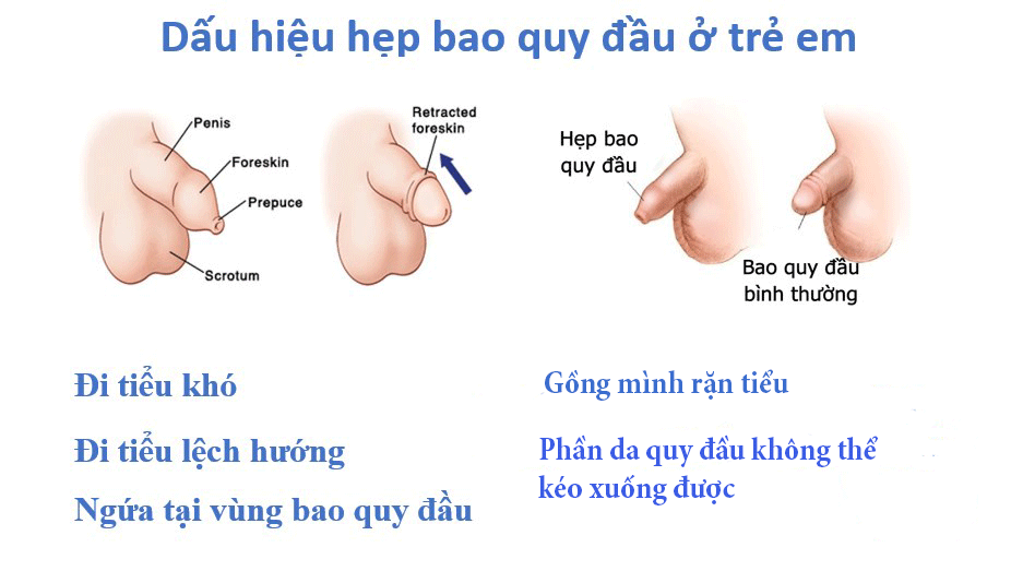 Hẹp bao quy đầu ở trẻ nhỏ và cách xử lý thông minh
