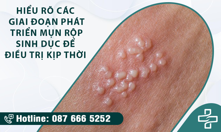 [Tìm hiểu] Các giai đoạn phát triển mụn rộp sinh dục & Cách chữa trị hiệu quả