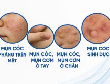 Các loại mụn cóc
