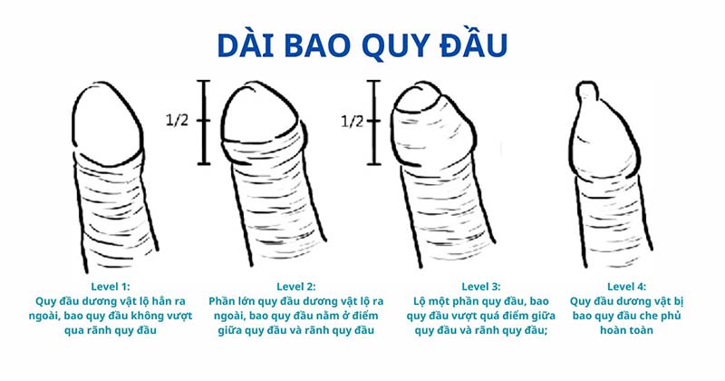 dài bao quy đầu
