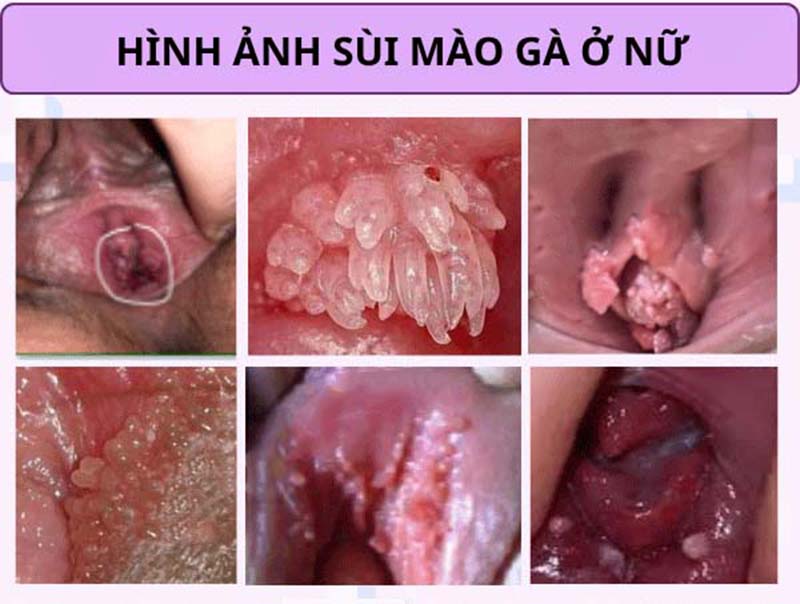sùi mào gà